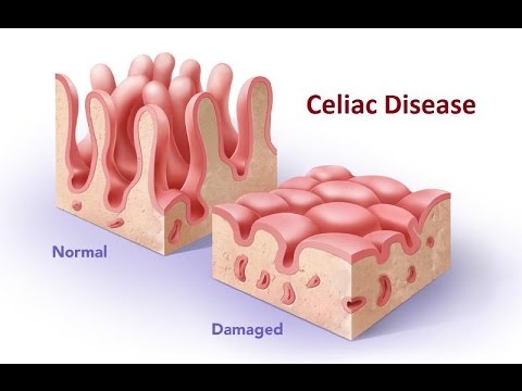 Celiac Disease